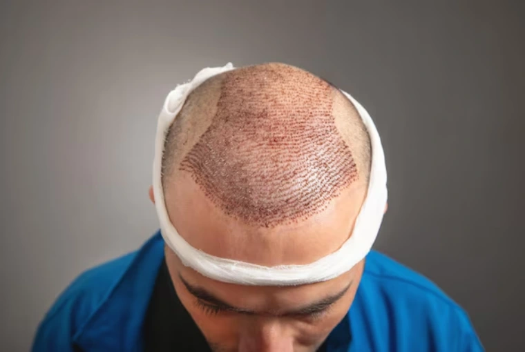 Direct Hair Transplant