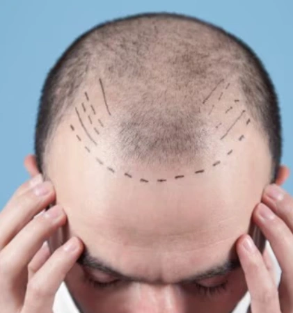 Unshaven Hair Transplant
