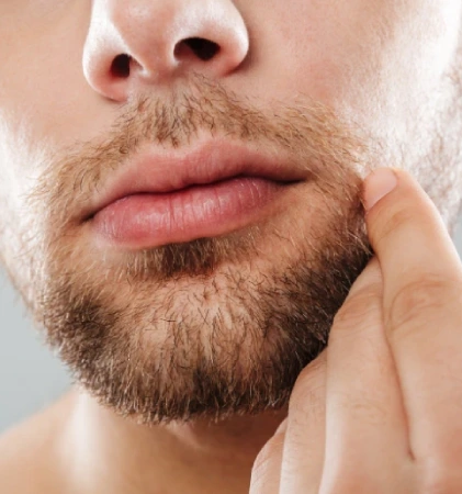 Moustache Hair Transplant