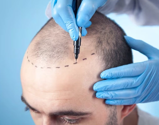 FUE Hair Transplant in Delhi