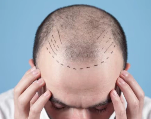 Unshaven Hair Transplant in Delhi