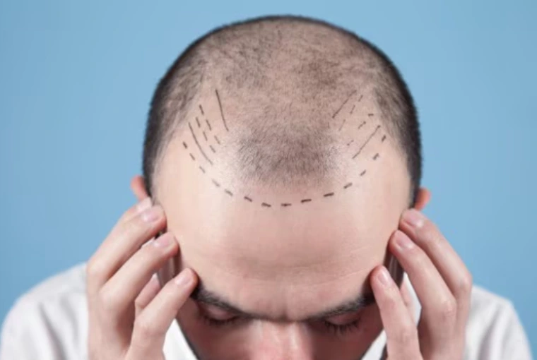Unshaven Hair Transplant in Delhi