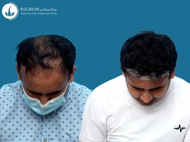 Male Hair Transplant