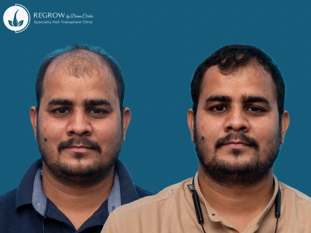 Male Hair Transplant