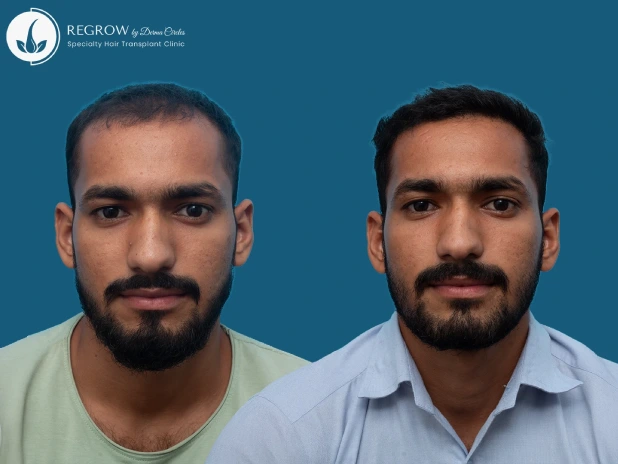 Male Hair Transplant
