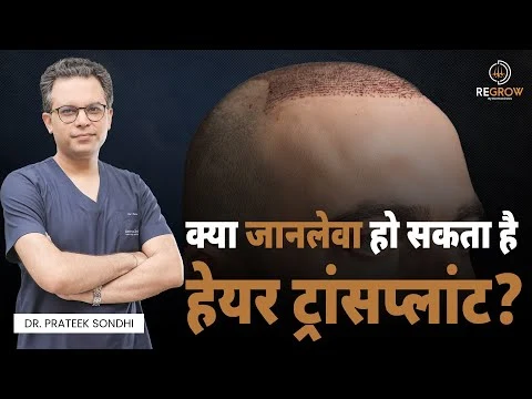 Can a Hair Transplant Be Life-Threatening? | Side Effects of a HairTransplant | Dr. Prateek Sondhi