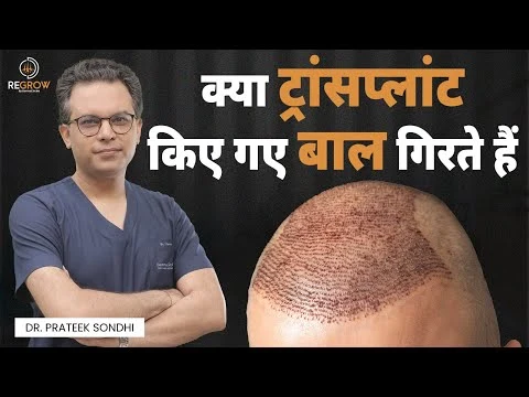 क्या ट्रांसप्लांट किए गए बाल गिरते हैं? | Are Hair Transplant Results Permanent? |Dr. Prateek Sondhi