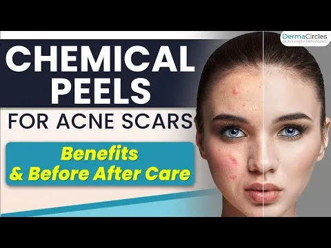 Chemical Peeling Treatment For Acne Scars | Skin Care Before & After Peeling, Benefits