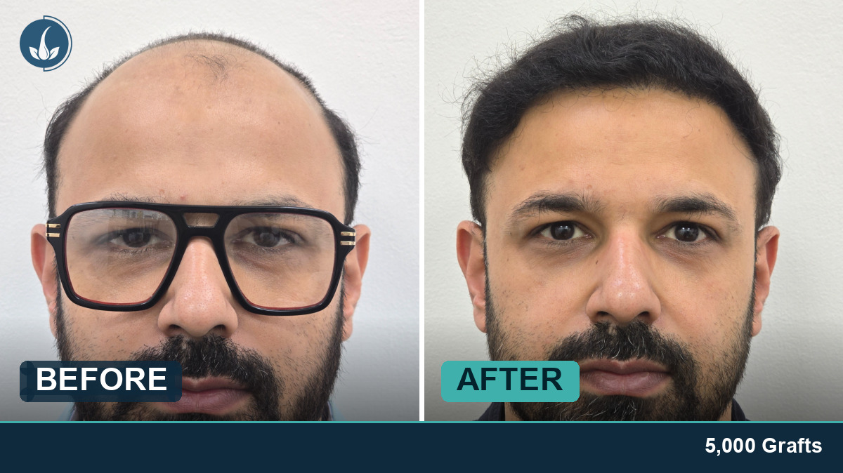 Hair transplant before and after — Regrow by Derma Circles