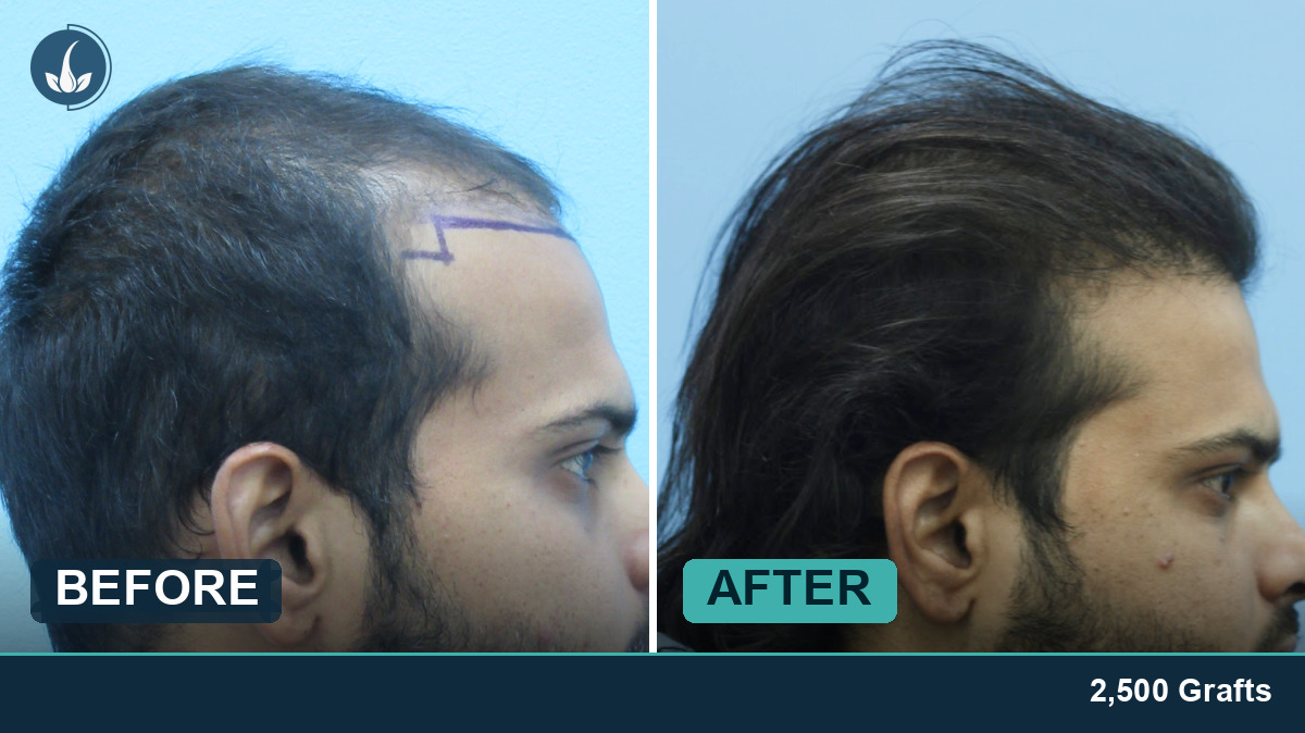 Hair transplant before and after — Regrow by Derma Circles