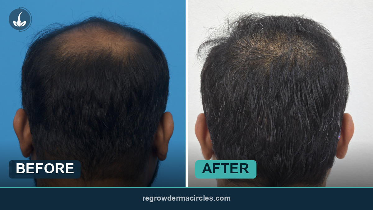 Hair transplant before and after — Regrow by Derma Circles
