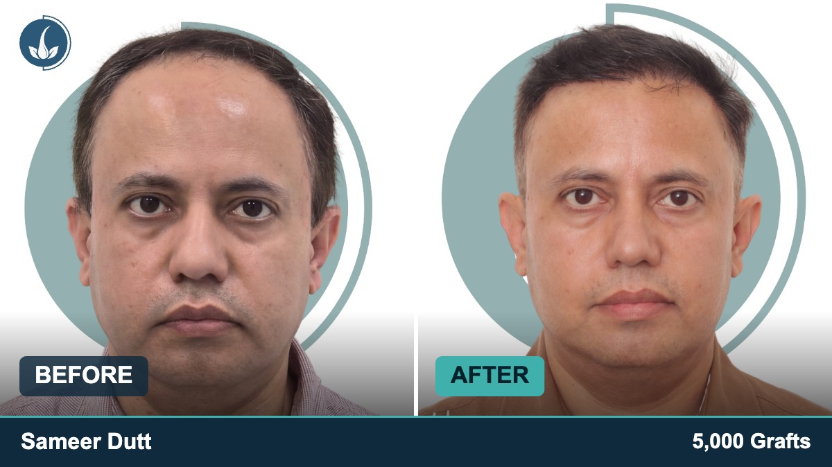 Hair transplant before and after — Regrow by Derma Circles